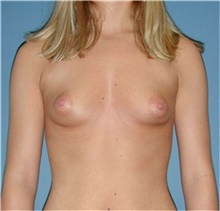 Breast Augmentation Before Photo by Karol Gutowski, MD, FACS; Glenview, IL - Case 39133