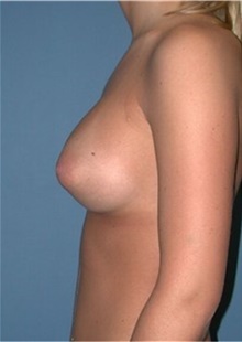 Breast Augmentation After Photo by Karol Gutowski, MD, FACS; Glenview, IL - Case 39133