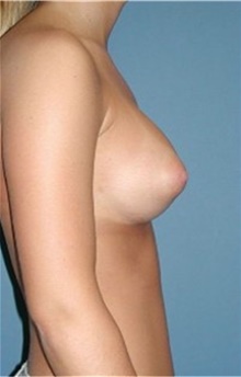 Breast Augmentation After Photo by Karol Gutowski, MD, FACS; Glenview, IL - Case 39133