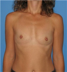 Breast Augmentation Before Photo by Karol Gutowski, MD, FACS; Glenview, IL - Case 39135