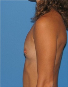 Breast Augmentation Before Photo by Karol Gutowski, MD, FACS; Glenview, IL - Case 39135