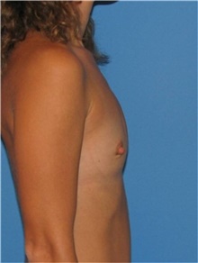 Breast Augmentation Before Photo by Karol Gutowski, MD, FACS; Glenview, IL - Case 39135