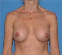 Breast Augmentation After Photo by Karol Gutowski, MD, FACS; Glenview, IL - Case 39136