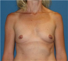 Breast Augmentation Before Photo by Karol Gutowski, MD, FACS; Glenview, IL - Case 39136