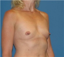 Breast Augmentation Before Photo by Karol Gutowski, MD, FACS; Glenview, IL - Case 39136