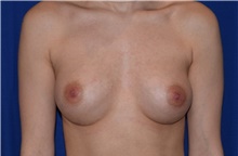 Breast Augmentation After Photo by Karol Gutowski, MD, FACS; Glenview, IL - Case 39137
