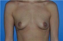 Breast Augmentation Before Photo by Karol Gutowski, MD, FACS; Glenview, IL - Case 39137