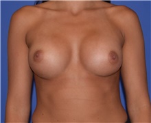 Breast Augmentation After Photo by Karol Gutowski, MD, FACS; Glenview, IL - Case 39138