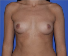 Breast Augmentation Before Photo by Karol Gutowski, MD, FACS; Glenview, IL - Case 39138