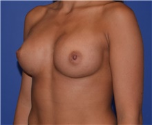 Breast Augmentation After Photo by Karol Gutowski, MD, FACS; Glenview, IL - Case 39138