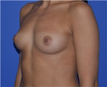 Breast Augmentation Before Photo by Karol Gutowski, MD, FACS; Glenview, IL - Case 39138