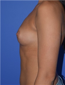 Breast Augmentation Before Photo by Karol Gutowski, MD, FACS; Glenview, IL - Case 39138