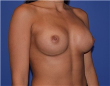 Breast Augmentation After Photo by Karol Gutowski, MD, FACS; Glenview, IL - Case 39138