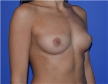 Breast Augmentation Before Photo by Karol Gutowski, MD, FACS; Glenview, IL - Case 39138