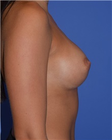 Breast Augmentation After Photo by Karol Gutowski, MD, FACS; Glenview, IL - Case 39138