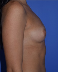 Breast Augmentation Before Photo by Karol Gutowski, MD, FACS; Glenview, IL - Case 39138