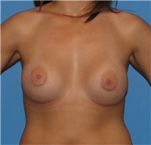 Breast Augmentation After Photo by Karol Gutowski, MD, FACS; Glenview, IL - Case 39139