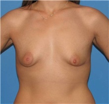 Breast Augmentation Before Photo by Karol Gutowski, MD, FACS; Glenview, IL - Case 39139