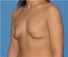 Breast Augmentation Before Photo by Karol Gutowski, MD, FACS; Glenview, IL - Case 39139