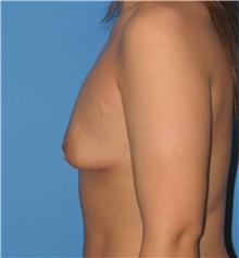 Breast Augmentation Before Photo by Karol Gutowski, MD, FACS; Glenview, IL - Case 39139