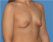 Breast Augmentation Before Photo by Karol Gutowski, MD, FACS; Glenview, IL - Case 39139