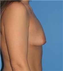 Breast Augmentation Before Photo by Karol Gutowski, MD, FACS; Glenview, IL - Case 39139