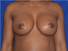 Breast Augmentation After Photo by Karol Gutowski, MD, FACS; Glenview, IL - Case 39141