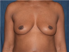 Breast Augmentation Before Photo by Karol Gutowski, MD, FACS; Glenview, IL - Case 39141