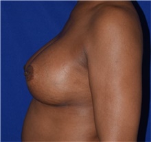 Breast Augmentation After Photo by Karol Gutowski, MD, FACS; Glenview, IL - Case 39141