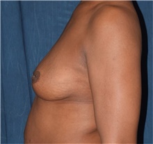 Breast Augmentation Before Photo by Karol Gutowski, MD, FACS; Glenview, IL - Case 39141