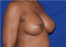 Breast Augmentation After Photo by Karol Gutowski, MD, FACS; Glenview, IL - Case 39141