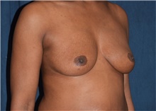 Breast Augmentation Before Photo by Karol Gutowski, MD, FACS; Glenview, IL - Case 39141