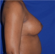 Breast Augmentation After Photo by Karol Gutowski, MD, FACS; Glenview, IL - Case 39141