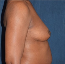 Breast Augmentation Before Photo by Karol Gutowski, MD, FACS; Glenview, IL - Case 39141