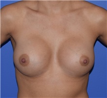 Breast Augmentation After Photo by Karol Gutowski, MD, FACS; Glenview, IL - Case 39142