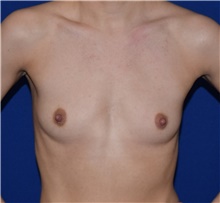 Breast Augmentation Before Photo by Karol Gutowski, MD, FACS; Glenview, IL - Case 39142