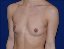 Breast Augmentation Before Photo by Karol Gutowski, MD, FACS; Glenview, IL - Case 39142