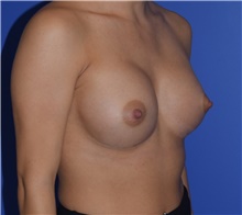 Breast Augmentation After Photo by Karol Gutowski, MD, FACS; Glenview, IL - Case 39142