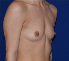 Breast Augmentation Before Photo by Karol Gutowski, MD, FACS; Glenview, IL - Case 39142