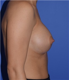 Breast Augmentation After Photo by Karol Gutowski, MD, FACS; Glenview, IL - Case 39142