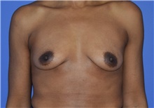 Breast Augmentation Before Photo by Karol Gutowski, MD, FACS; Glenview, IL - Case 39143