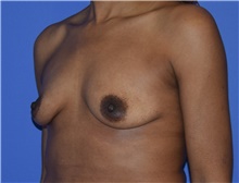 Breast Augmentation Before Photo by Karol Gutowski, MD, FACS; Glenview, IL - Case 39143