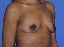 Breast Augmentation Before Photo by Karol Gutowski, MD, FACS; Glenview, IL - Case 39143