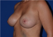 Breast Augmentation After Photo by Karol Gutowski, MD, FACS; Glenview, IL - Case 39144