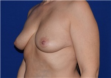 Breast Augmentation Before Photo by Karol Gutowski, MD, FACS; Glenview, IL - Case 39144