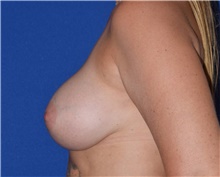 Breast Augmentation After Photo by Karol Gutowski, MD, FACS; Glenview, IL - Case 39144