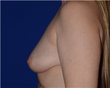 Breast Augmentation Before Photo by Karol Gutowski, MD, FACS; Glenview, IL - Case 39144