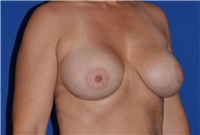 Breast Augmentation After Photo by Karol Gutowski, MD, FACS; Glenview, IL - Case 39144