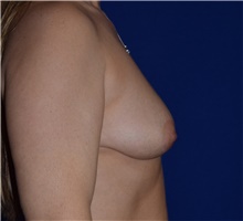 Breast Augmentation Before Photo by Karol Gutowski, MD, FACS; Glenview, IL - Case 39144