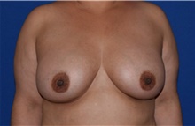 Breast Augmentation After Photo by Karol Gutowski, MD, FACS; Glenview, IL - Case 39145